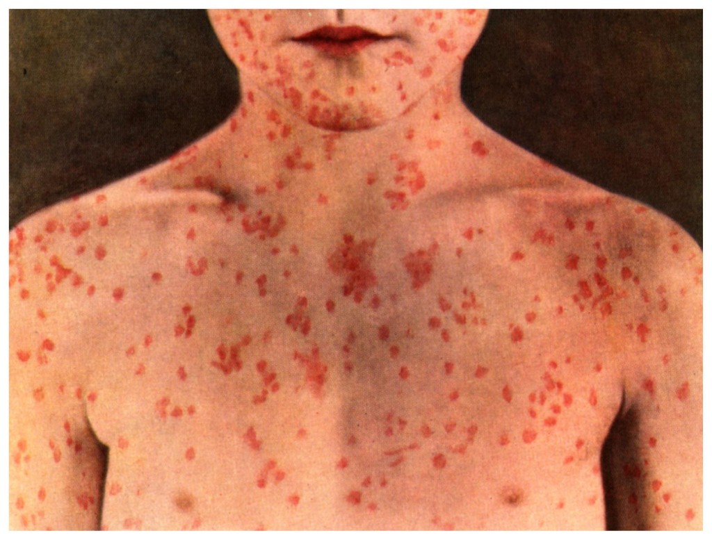 measles